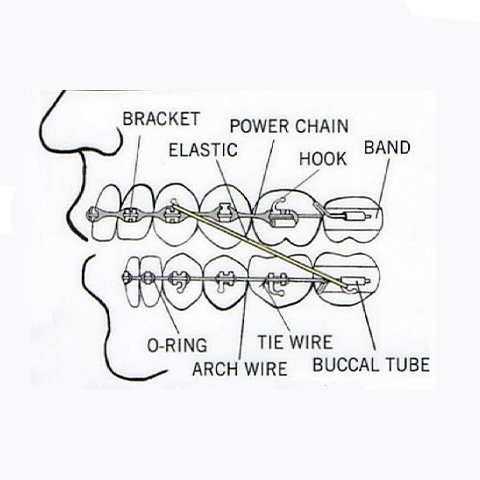 orthodontic appliances on teeth